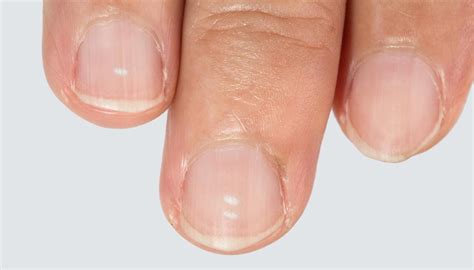 This Is Why You Get White Spots On Your Nails Nova 1069