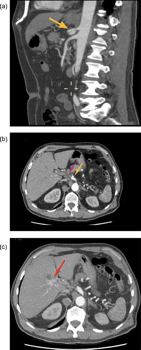 A Recent Ct Angiogram 2019 Shows Celiac Artery Dissection Yellow