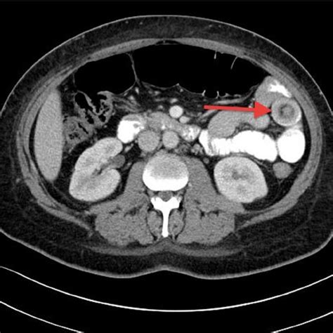 Pdf Transient Small Bowel Intussusception In An Adult Case Report