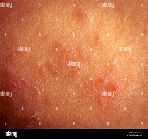Eczema Atopic Dermatitis Symptom Skin Texture Stock Photo Alamy