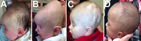 Hydrocephalus Before And After
