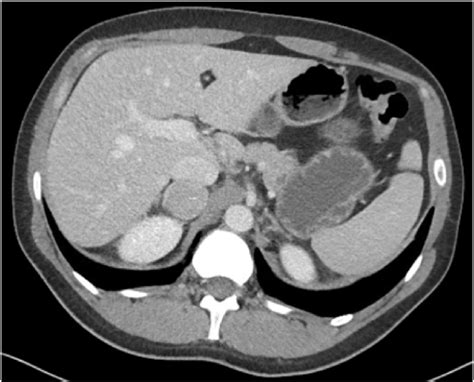Contrast Enhanced Abdominal Computed Tomography Ct Scan Reveals A