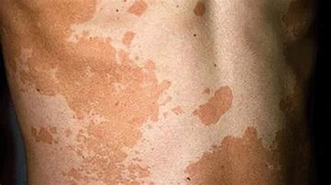 What Causes White Spots On Skin