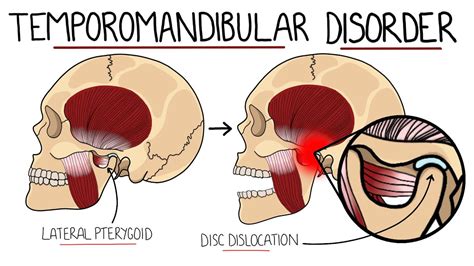 Temporomandibular Joint Disorder Explained Tmj Dysfunction Includes