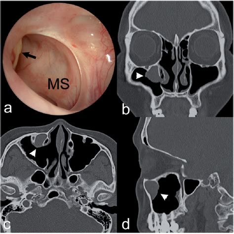 Maxillary Sinus Inverted Papilloma Semantic Scholar