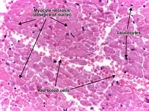 The term myocarditis refers to an inflammatory response within the myocardium that is not secondary to ischemic events or cardiac rejection in the setting of transplantation. موقع الدكتور أحمد كلحى: صور باثولوجى - ﻿Patholgy Slides : Cardiovascular pathology