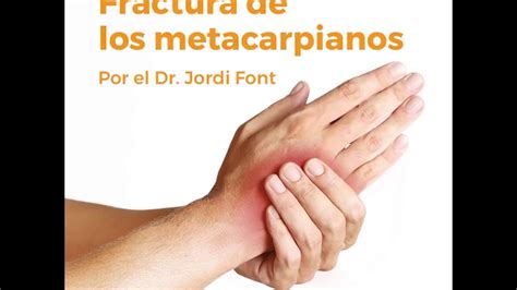 Lesión Fractura De Metacarpiano Por El Dr Jordi Font Especialista En