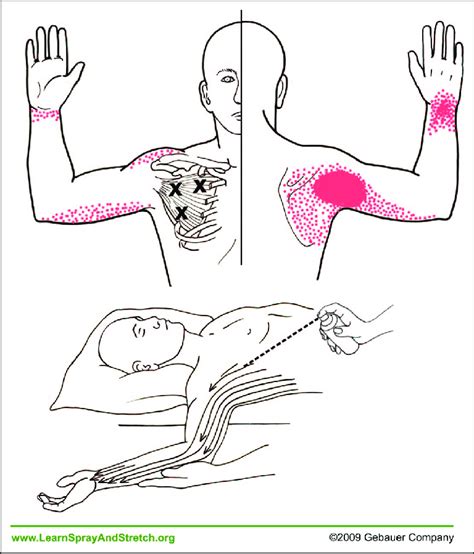 Spray And Stretch Technique For Treatment Of The Subscapularis ⋆ Santa