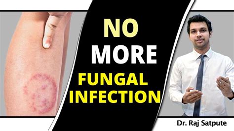 Treating Skin Fungal Infection From The Root Cause Fungal Infection