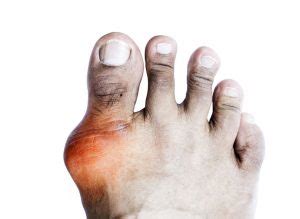What Causes Uric Acid Build-Up and Joint Discomfort? - LCR ...