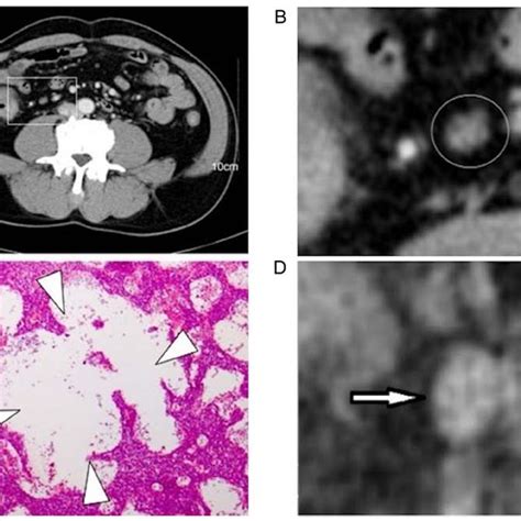 A Contrast Enhanced Equilibrium Phase Ct Scan Images Of A Lymph Node