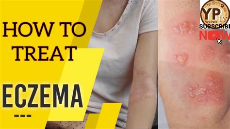 Eczema Also Known As Atopic Dermatitis Treatmentsmedications Types