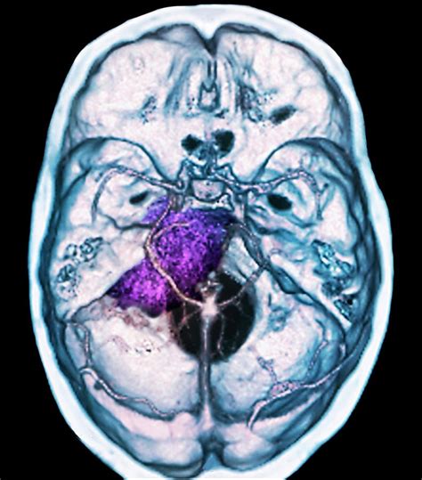Benign Brain Tumour Photograph By Zephyr Pixels