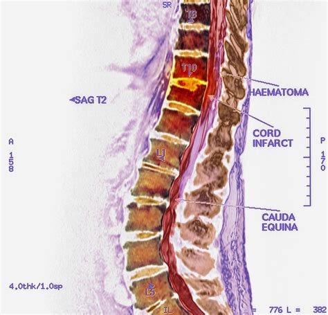 Spinal Cord Stroke Mri Scan 1 Photograph By Pixels