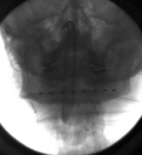 1 Intraoperative X Rays During Trial Occipital Nerve Stimulator