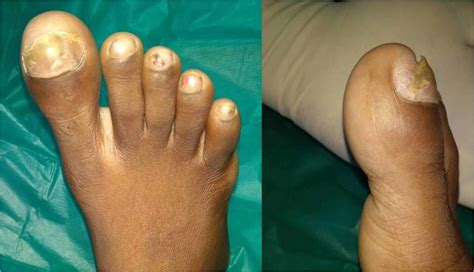 Cureus Chondromyxoid Fibroma Of Distal Phalanx Of The Great Toe A