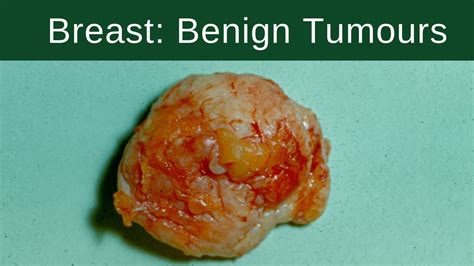 Benign Tumor Definition Of Benign Tumor By Medical