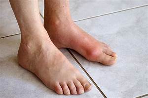 Gout Treatment at Home Gout  