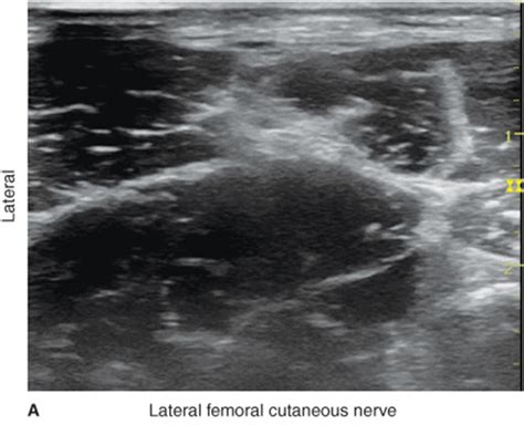 Lateral Femoral Cutaneous Nerve Treatment