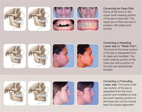 Corrective Jaw Surgery Pottstown Oral Surgery Blog