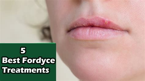 Fordyce Spots On Lips Medicine