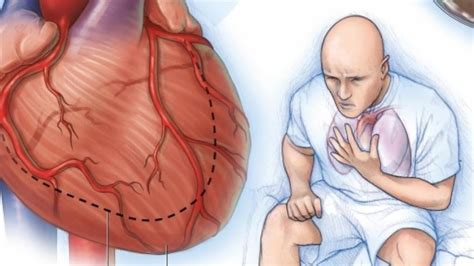 Derrame Pleural Mapa Mental