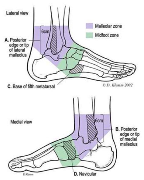 Do I Need An X Ray Simple Ankle And Foot Rules Osi Physical Therapy