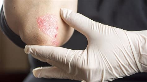 Psoriasis Treatment Cost Of Key Drug To Be Slashed The Courier Mail