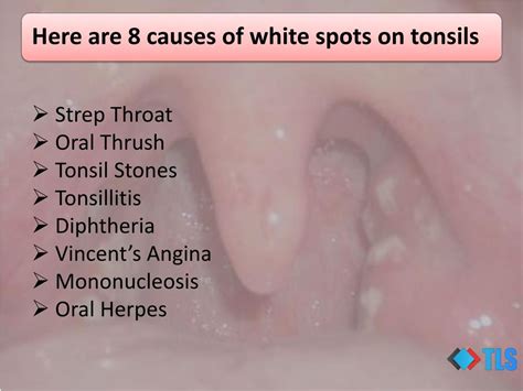 PPT Causes Of White Spots On Tonsils You May Not Know PowerPoint Presentation ID