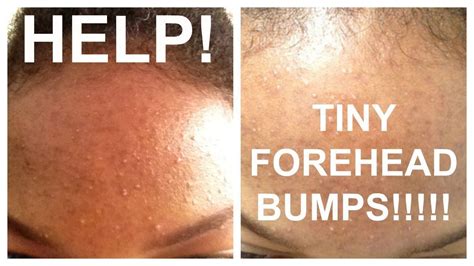 How To Get Rid Of Tiny Forehead Bumps Skincreamdiy