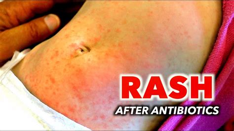 Rash After Antibiotics Is This An Allergic Reaction Dr