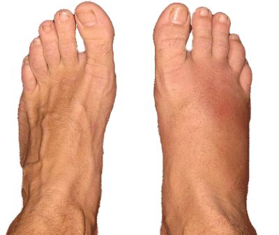 For a minor fracture, realignment of bones might not be necessary and treatment typically. Ways to Treat and Prevent Stress Fracture in Foot | New ...