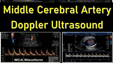 Middle Cerebral Artery Doppler Ultrasound Interpretation Ultrasound