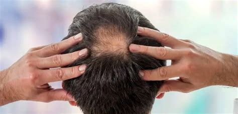 What Causes Bald Spots On Head Design Talk