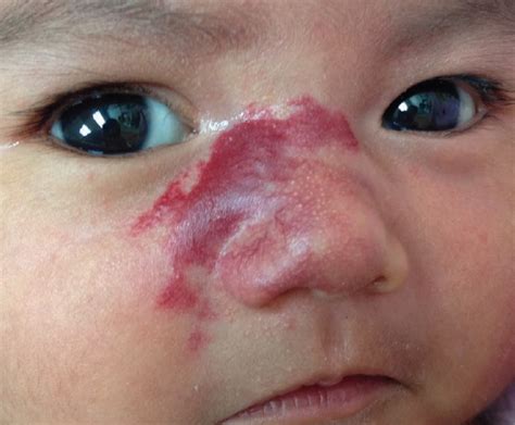 Infantile Hemangioma Management Of A Girls Growing Facial Lesion