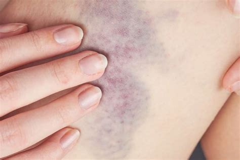 9 Leukemia Rashes Bruises And Other Skin Manifestations Page 3 Of 9