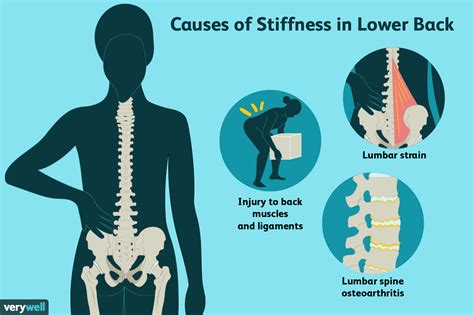 Cause And Treatment Of Low Back Stiffness