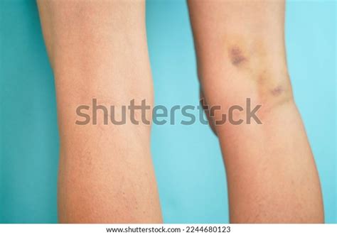 Large Hematoma On Leg Below Knee Stock Photo 2244680123 Shutterstock