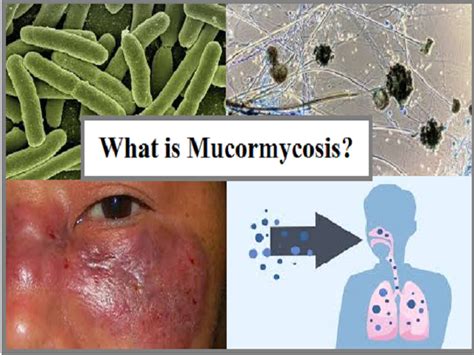 Urgent surgical and medical intervention is lifesaving. Mucormycosis, a rare Fungal Infection linked to COVID-19 ...
