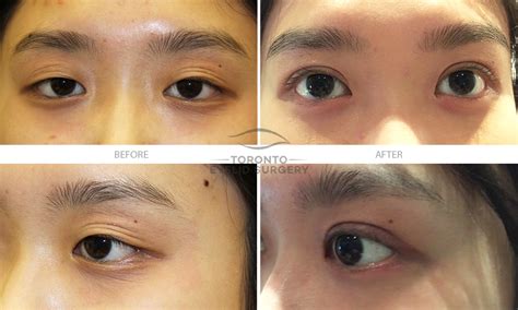 Before And After Toronto Eyelid Surgery