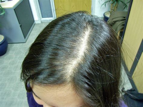 Hair has a growth stage and a resting stage. The Hair Loss Centre | Female Hair Loss: Early ...