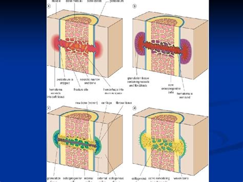 Musculoskeletal Block Pathology Lecture 1 Fracture And Bone