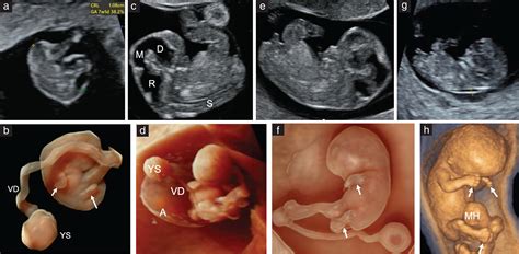 Sonographic detection of fetal abnormalities before 11 weeks of