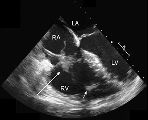 James ramsay md university of california, san francisco. Device-Related Endocarditis and Infected Leads Extraction ...