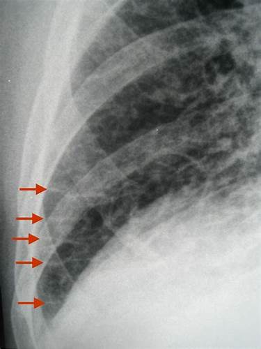 Сердечная недостаточность на диете Сердечная недостаточность на рентгене легких - фото презентация Сердечная недостаточность на рентгене легких - фото презентация Сердечная недостаточность на диете