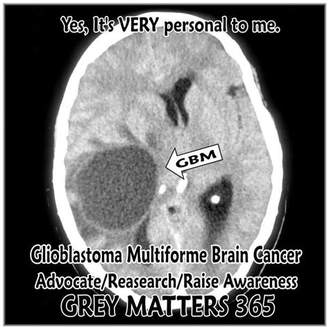 What Happens In The Final Stages Of Glioblastoma Chunky Portal Photos