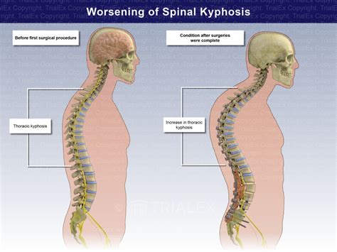 Worsening Of Spinal Kyphosis Trialexhibits Inc