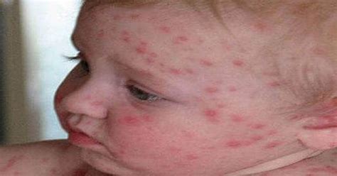 Chickenpox Rash Causes Symptoms Treatment Chickenpox Rash SexiezPix