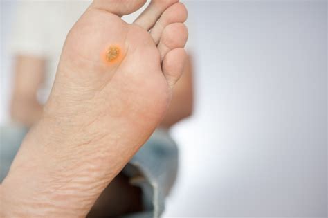 Diabetic Foot Ulcers Why Diabetics Are At Higher Risk Symptoms
