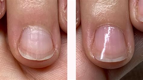 Overgrown Cuticle Or Stretched Proximal Nail Fold 2 Week Progress